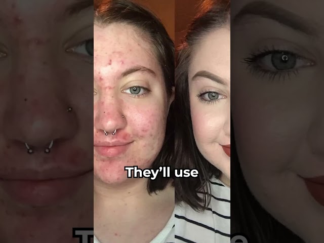 Birth Control Is NOT Real Acne Treatment