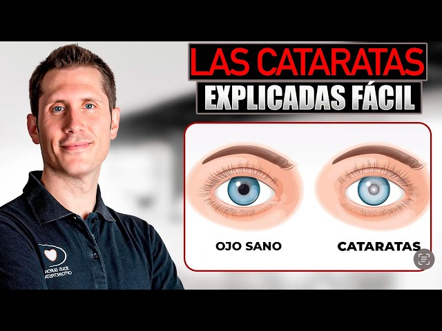 ✅ ¿Que son las CATARATAS de TUS OJOS?
