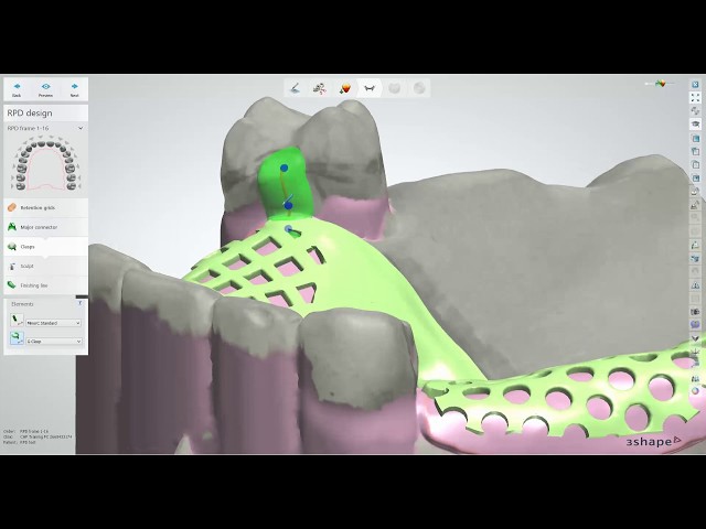 Dental Lab Life: Scanning and Designing a Removable Partial Denture Using 3Shape