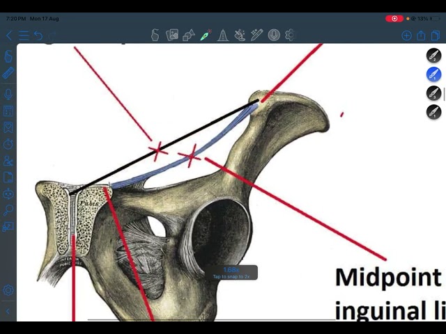 Inguinal hernia (GIT surgery