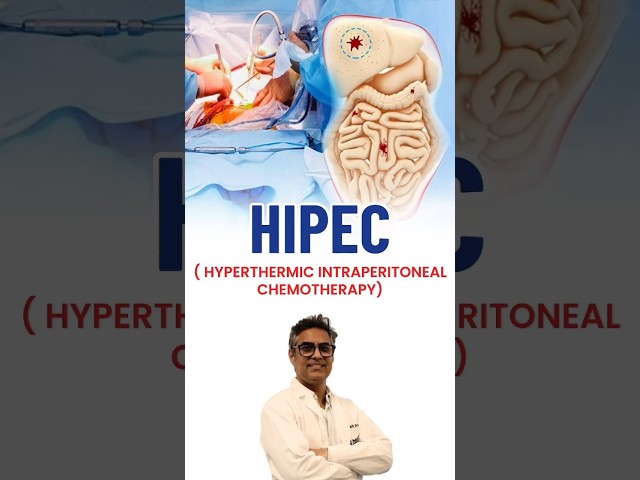HIPEC Treatment: New Hope for Stage 4 Abdominal Cancers Explained by Dr. Asit Arora