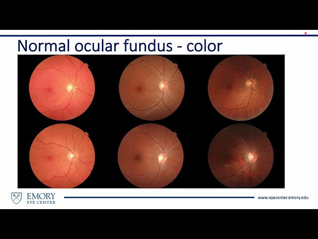 How to Interpret the Ocular Fundus of a Photograph from a Nonmydriatic Camera