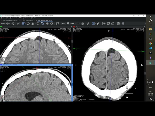Raw DICOM in description, Foreign body on CT high bitrate, quality 23.05.2024