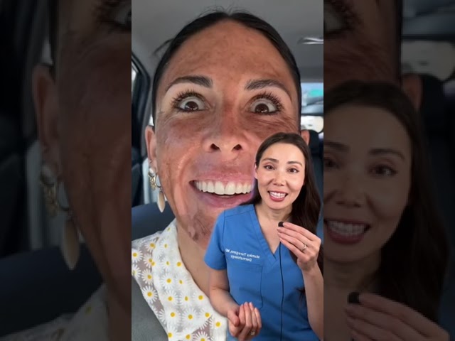 Peeling químico con TCA