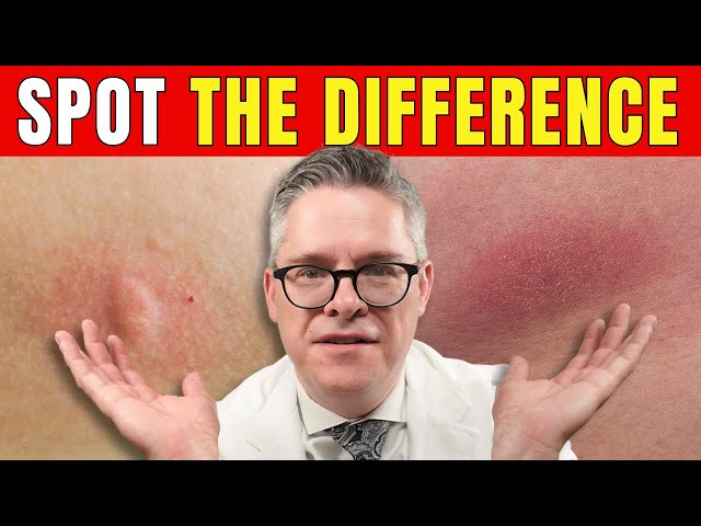 Lyme Disease vs. Spider Bite: How to Tell the Difference