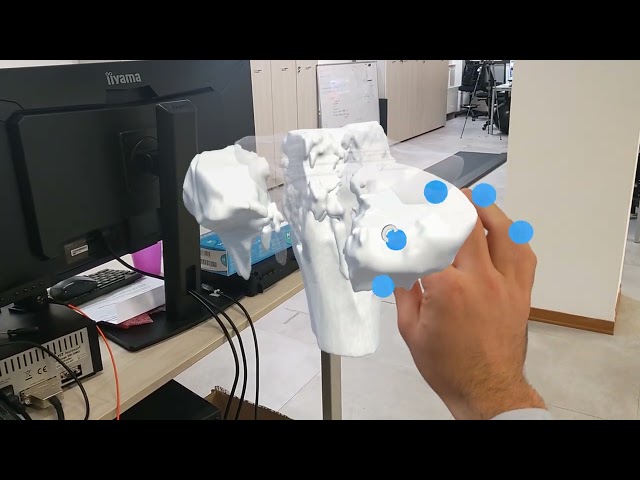 MR-Powered Surgical Planning for Accurate Bone Fracture Reduction
