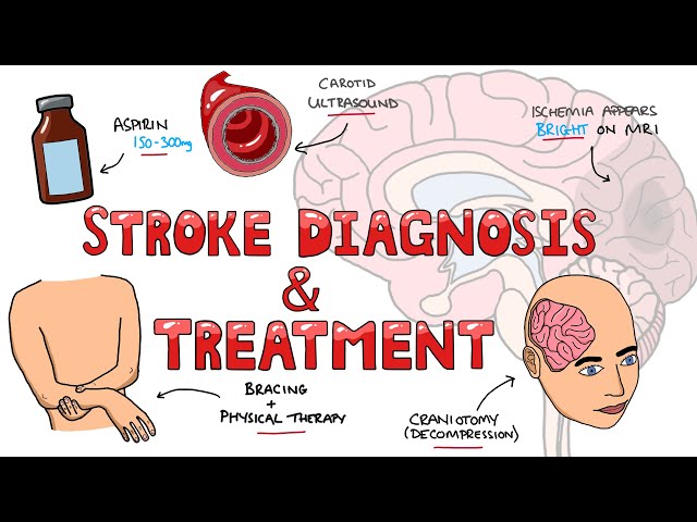 Stroke Diagnosis and Treatment - Acute and Long Term Treatment of Ischemic and Hemorrhagic Stroke