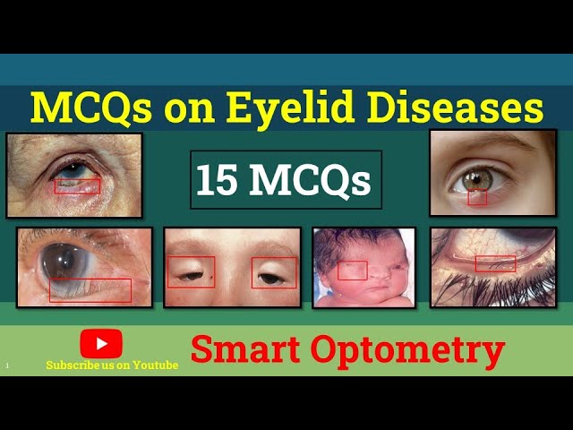 MCQs- Eyelid Diseases (DHA/HAAD/MOH)