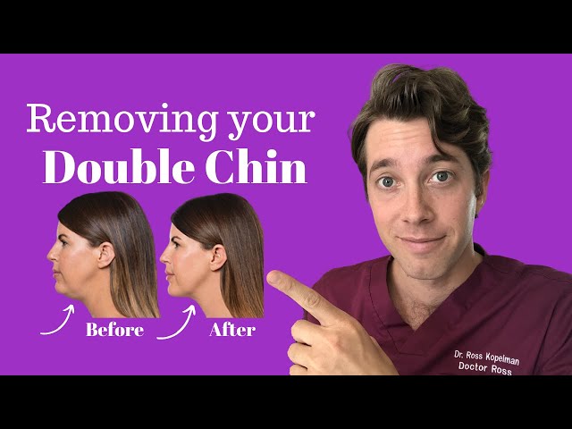 ¿Qué es Kybella? | Eliminador de papada | Dr. Kopelman