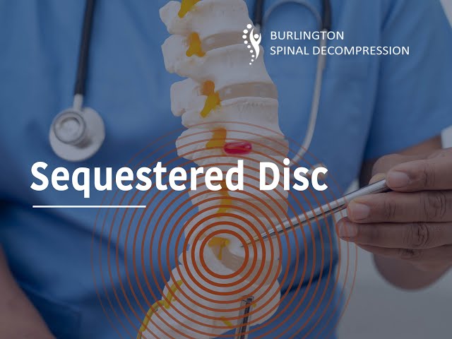 Sequestered Disc Explained | The Most Severe Type of Herniated Disc