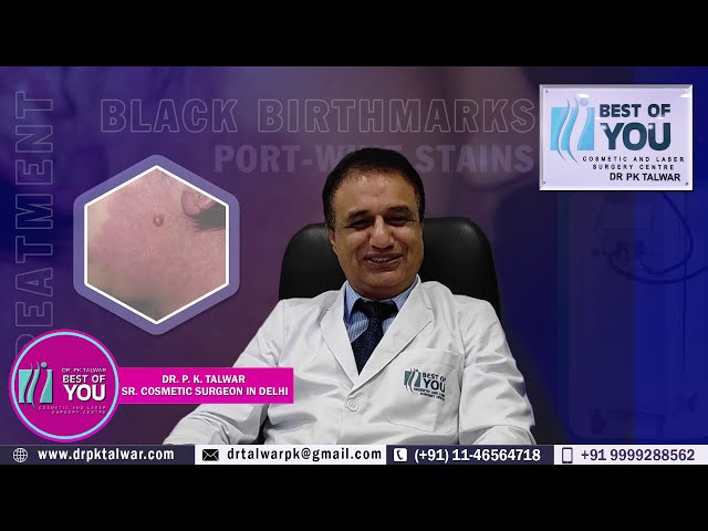 Black Birthmark Removal, Birthmark Removal in Delhi at Low Cost | Dr. PK Talwar
