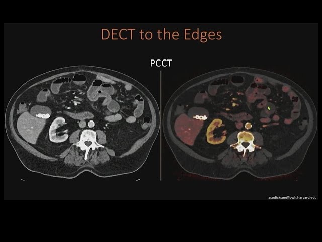 DECT to the Edges—Photon-Counting CT in the ED