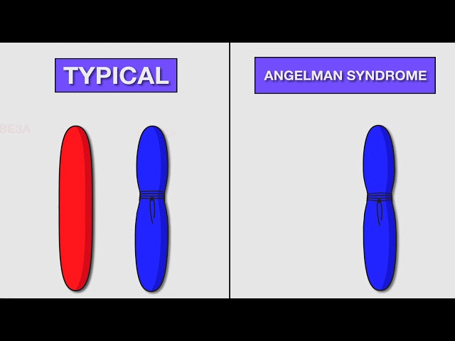 UNC Science Short: CRISPR/Cas9 to treat Angelman Syndrome