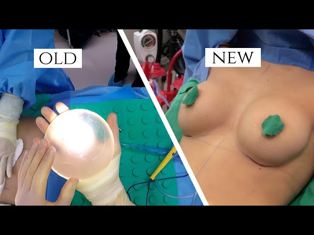 Breast Implant Removal and Replacement Surgery | Explant Breast Surgery in Beverly Hills