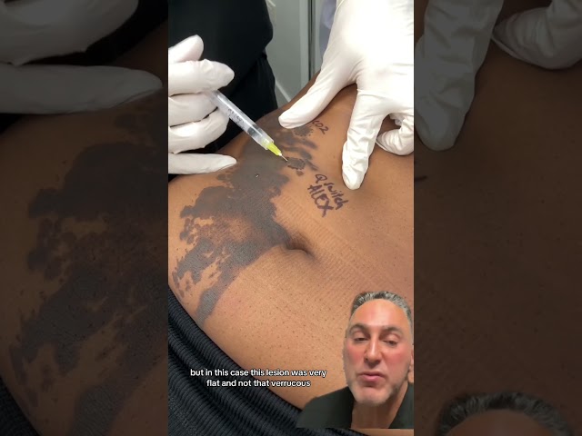 Test Spots with Various Lasers for Birthmark Removal