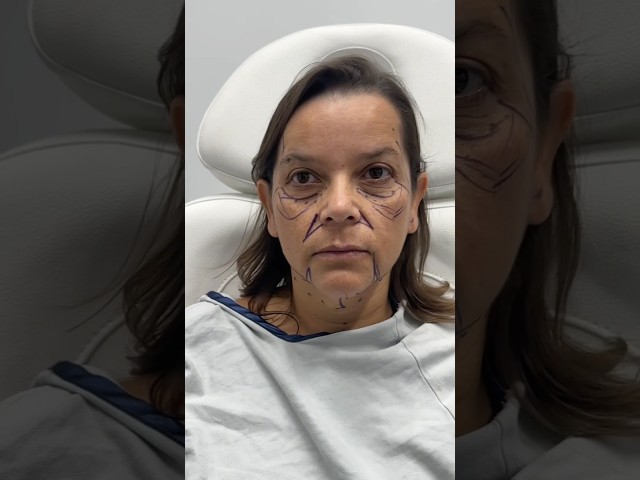I Took Away 15 Years 😱 Facelift Done Right! #plasticsurgery