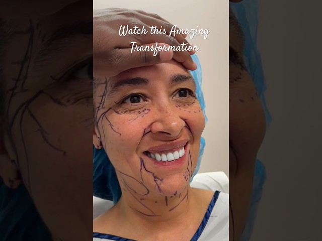 Unbelievable Crazy Plastic Surgery Transformation #plasticsurgeon #facelift