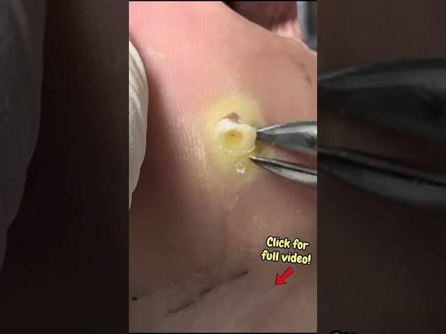 Part 6 - Shocking Corn Core Extraction #satisfying #satisfyingshorts #shortsfeed