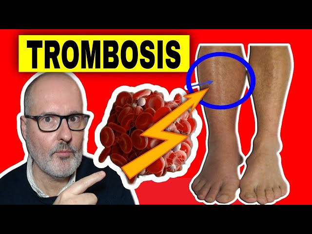 TROMBOSIS VENOSA PROFUNDA en PIERNAS: Causas, Síntomas, Prevención y Tratamiento