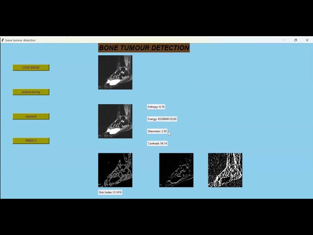 Bone Tumor Detection Using Image Processing Ai Tools || Final Year Projects || Python Projects