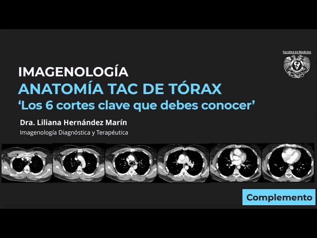 CHEST CT INTERPRETATION - The 6 sections you should know
