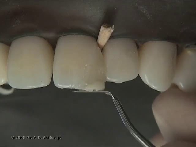 Class IV Composite Preparation & Restoration | Operative Dentistry