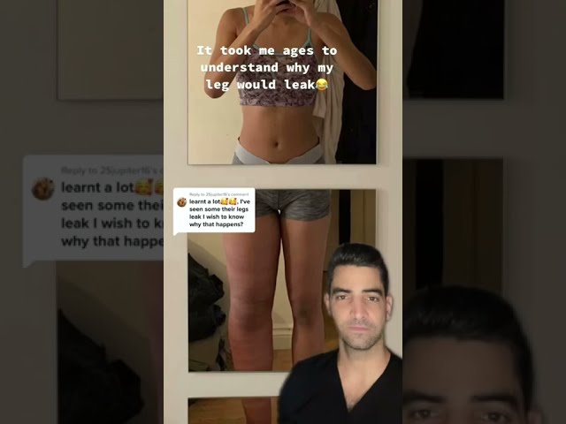 Lymphedema Leg Swelling