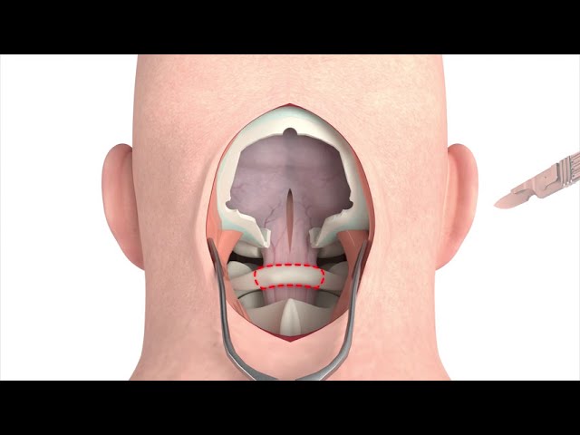 Craniectomy brain surgery - 3D animation