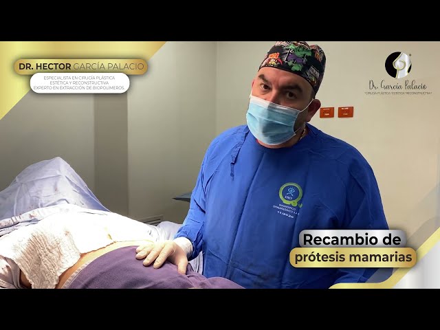 Recambio de prótesis mamarias