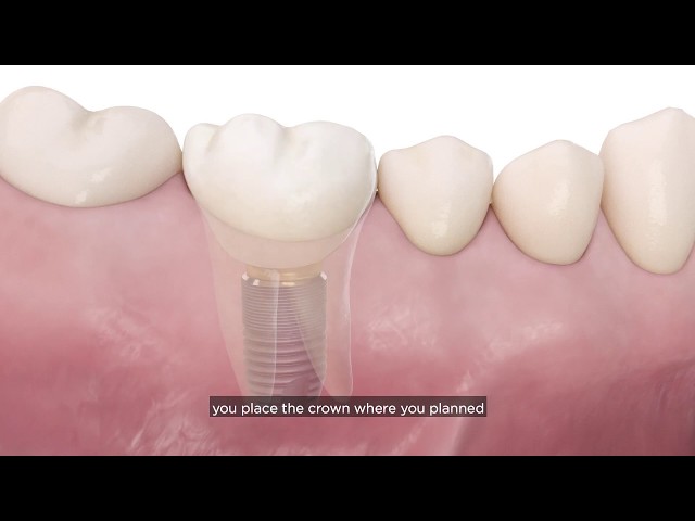 Incorporating a digital implant workflow into practice