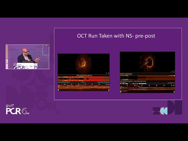 Global momentum of Shockwave intravascular lithotripsy: evidence, experience and evolution