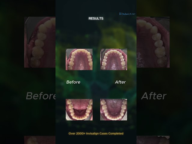 Invisalign for Overbite in London | Dulwich Dental Office | Clear Aligners to Correct Overbite