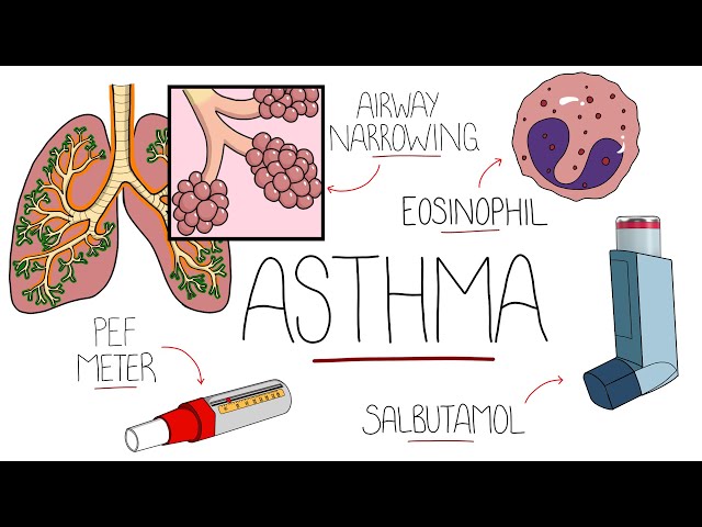 Asthma Explained (Including Pathophysiology)