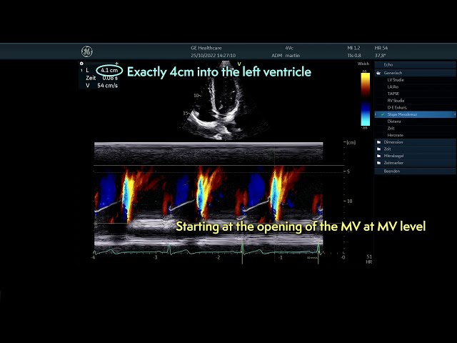 〖Echocardiography〗 Color M-Mode flow propagation measurement - diastolic function  🫀