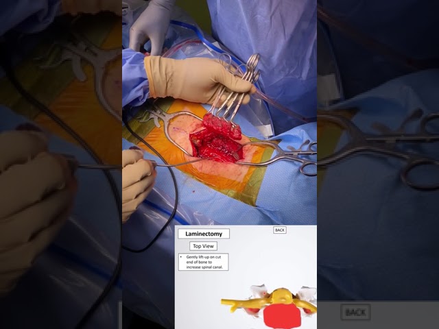 What is Posterior Cervical Decompression Surgery? 🤓