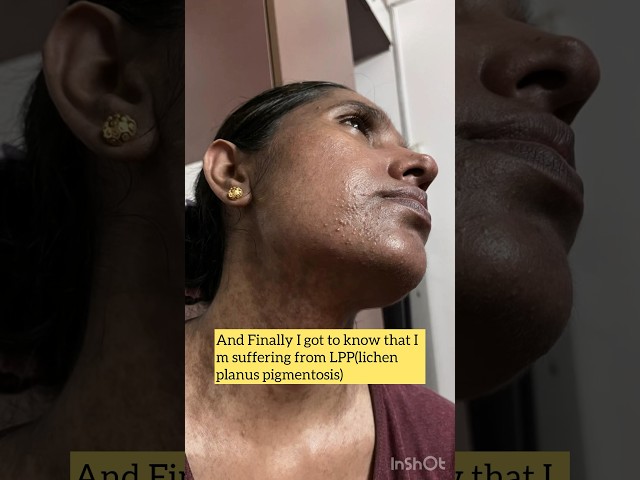 LPP can be cured with right medication and patience.Have faith in god and stay motivated 👍🏻