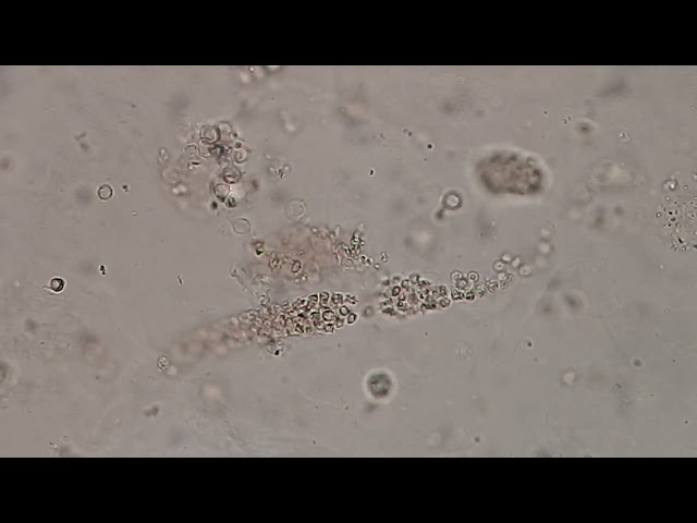 Red blood cells (RBC) Cast in Urine microscopy of renal patient