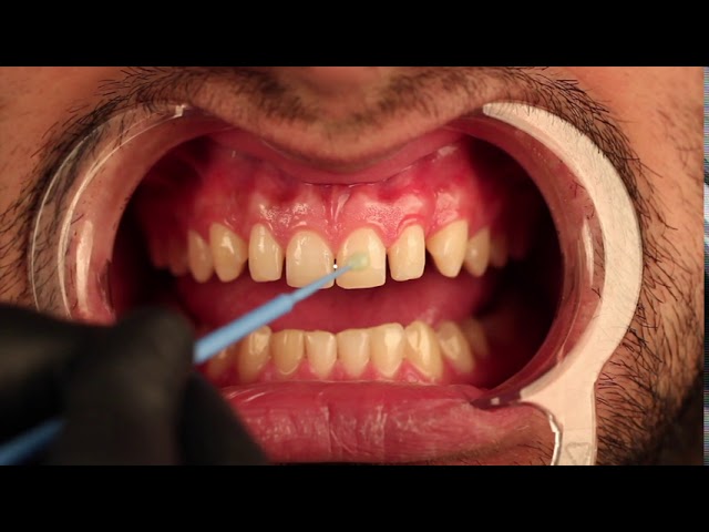 Dental Mock-Up