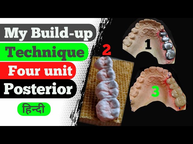Upper 4Unit Layering|| Metal Ceramic| How to layering ceramic| Dental Lab | Dental technician| India
