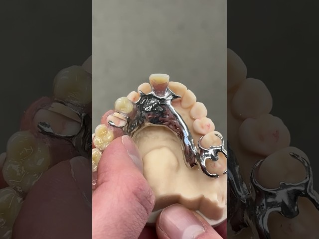 Cast Metal Partial @EnvisiontecMain #envisiontec #dental #teeth #smile #shorts #lsk121shorts