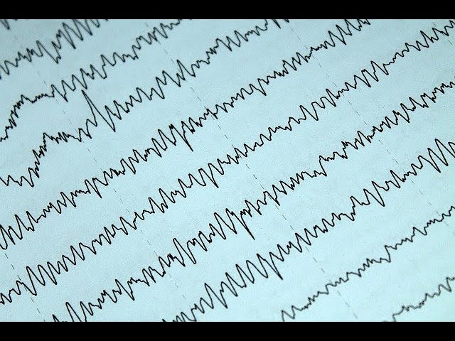 Electroconvulsive Therapy Explained