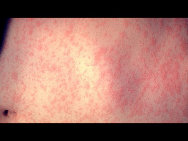 What parents need to know after five Georgia siblings were diagnosed with measles