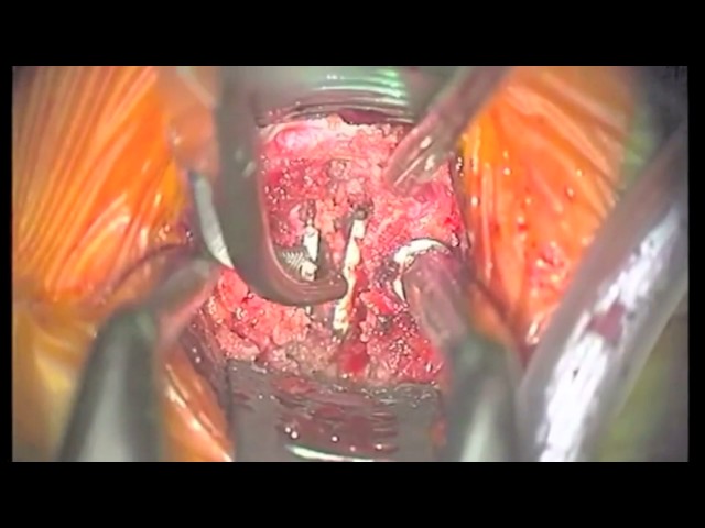 Surgical technique for revision surgery of cervical artificial disc replacements