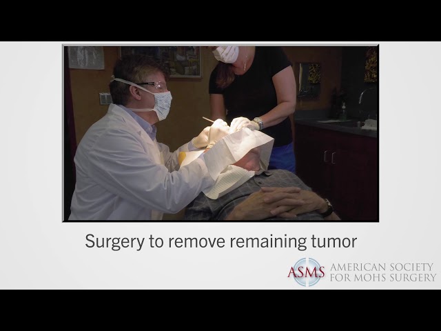 What is the Mohs Surgery Process? | ASMS