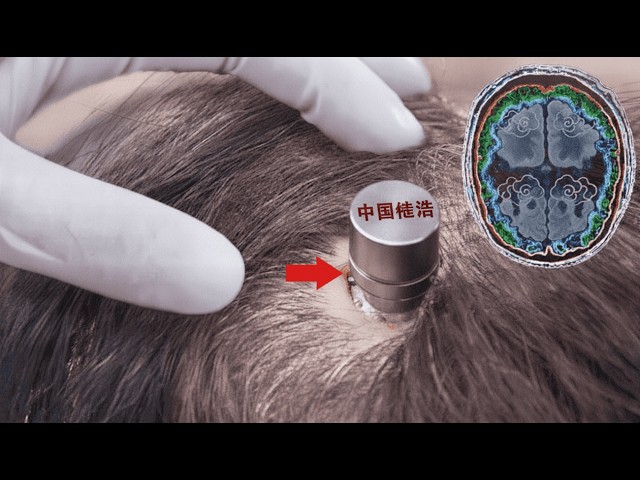 China Just Beat Elon Musk Inside the Human Brain
