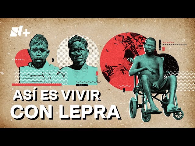 Lepra: ¿Qué es y cómo se contagia? - N+