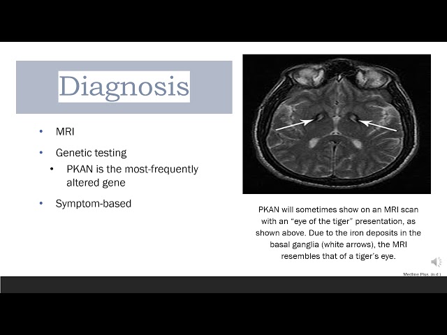 Neuro Degeneration with Brain Iron Accumulation - Teaching Project