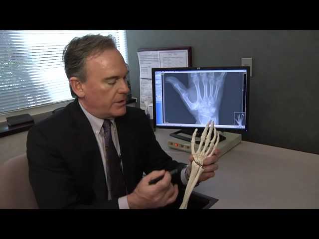 Treating Basal Thumb Joint Arthritis - Mayo Clinic