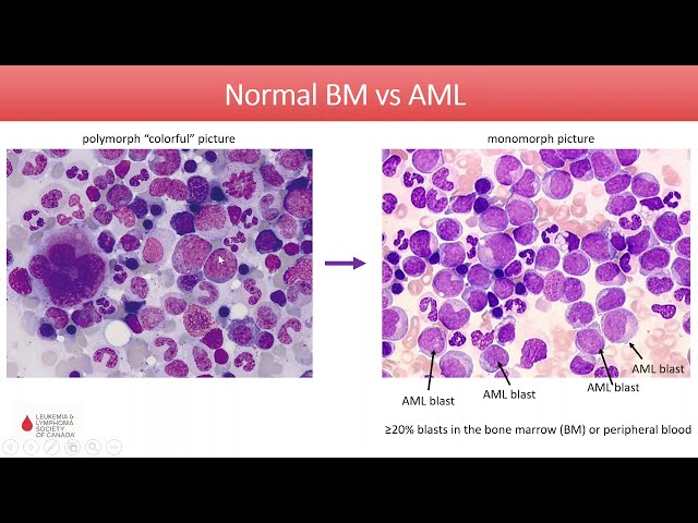 Acute Myeloid Leukemia - Diagnosis and Treatment in 2020