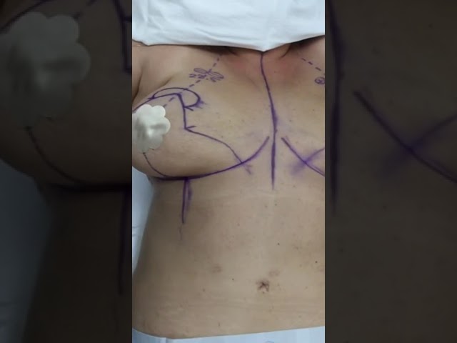 The Breast Reduction I Did This Morning! #shorts #plasticsurgeon #breastreduction